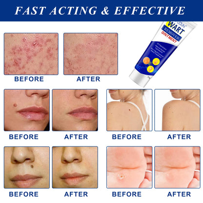 Crème anti-verrue révolutionnaire.