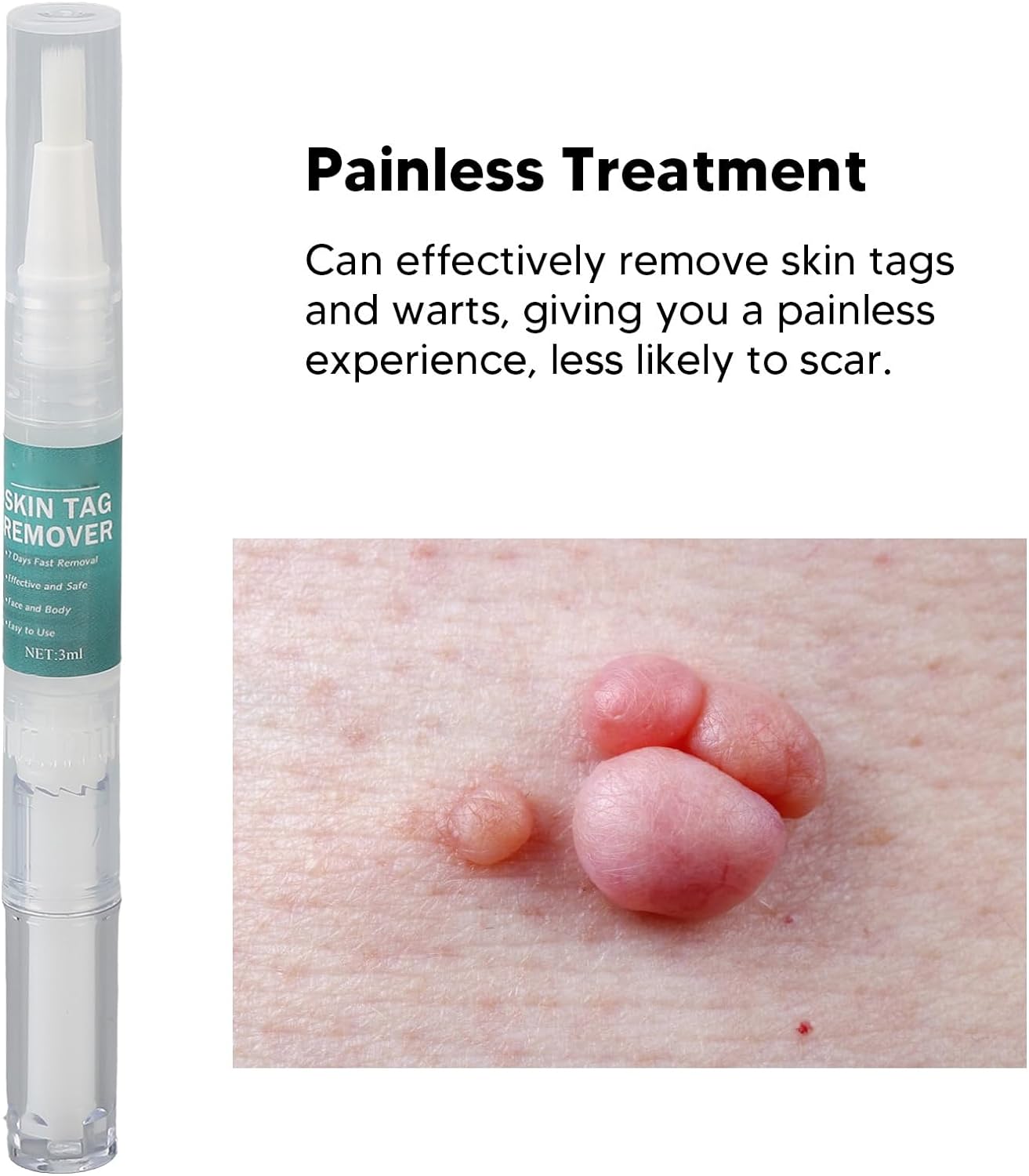 Stylo dissolvant anti-verrues efficace.