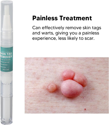 Stylo dissolvant anti-verrues efficace.