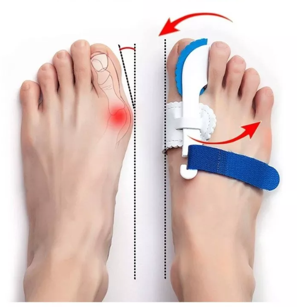 Paire d'attelles de correction d’orteils hallus valgus.