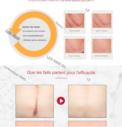 Gel pour l'élimination des cicatrices et des marques d'acné TCM.