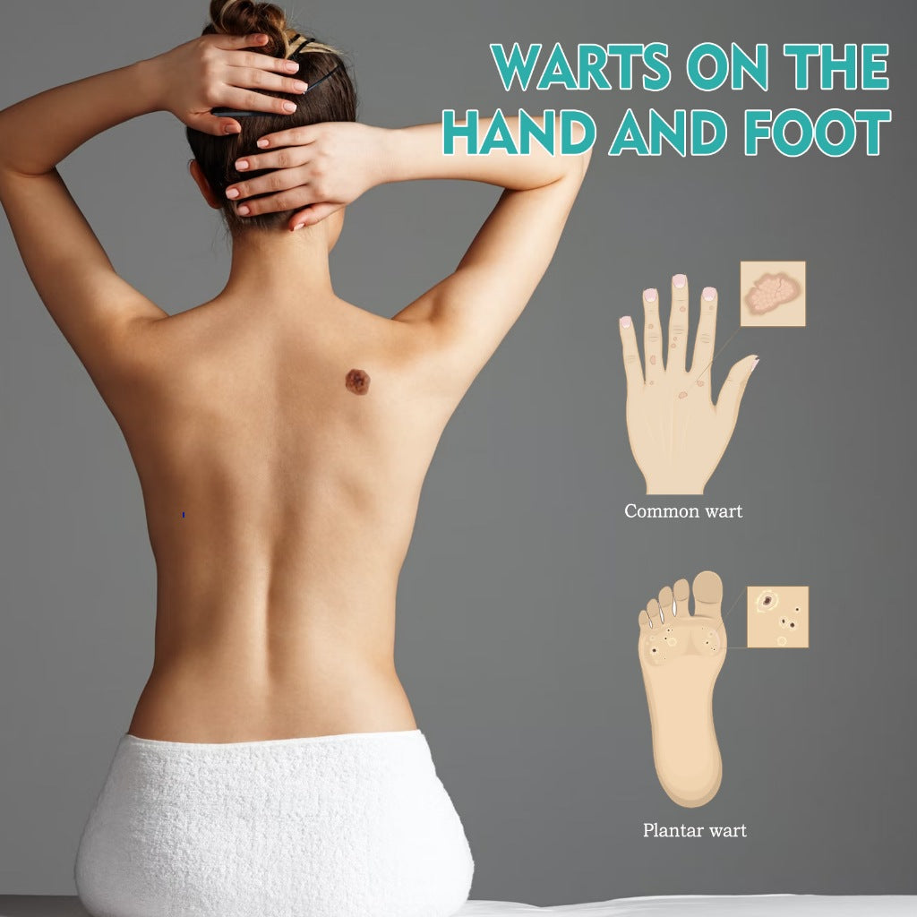 Stylo dissolvant anti-verrues efficace.