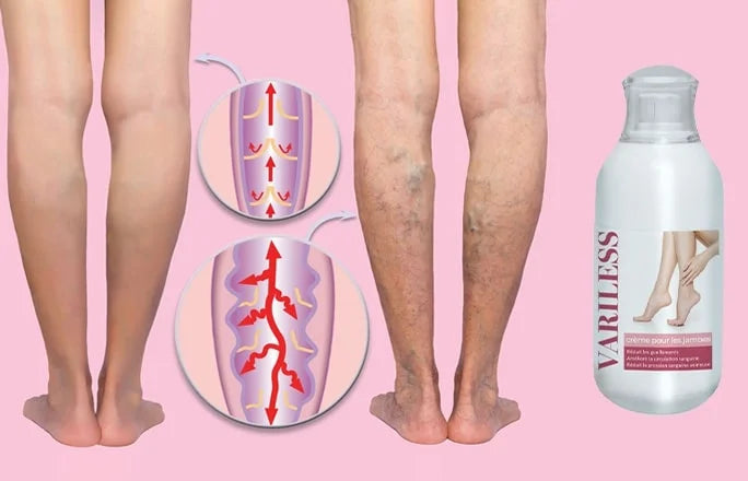 Crème aux herbes Variless pour traiter les varices